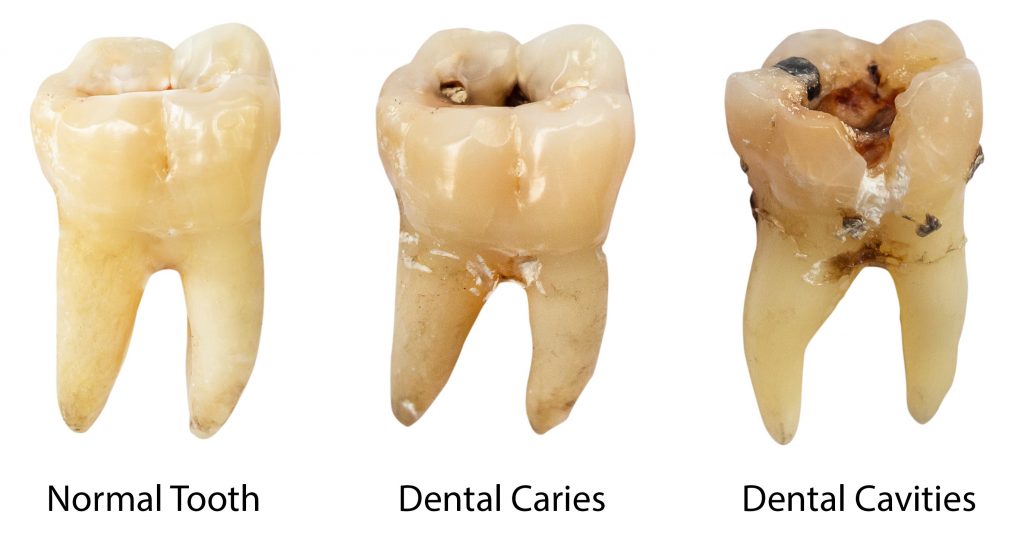 What Does Sugar Do To Your Teeth The Results Will Shock You 