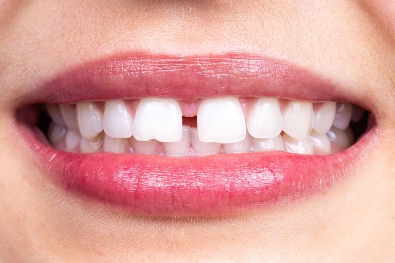 diastema-what-causes-gaps-in-teeth-and-what-solutions-are-available