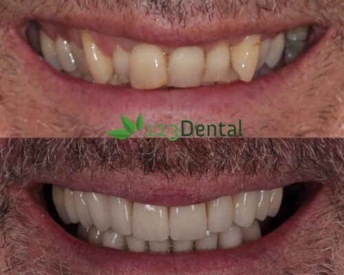 smile improvements with crowns