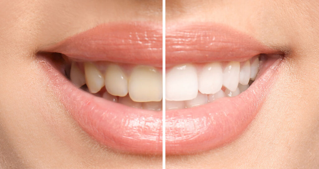 Teeth whitening before and after comparison