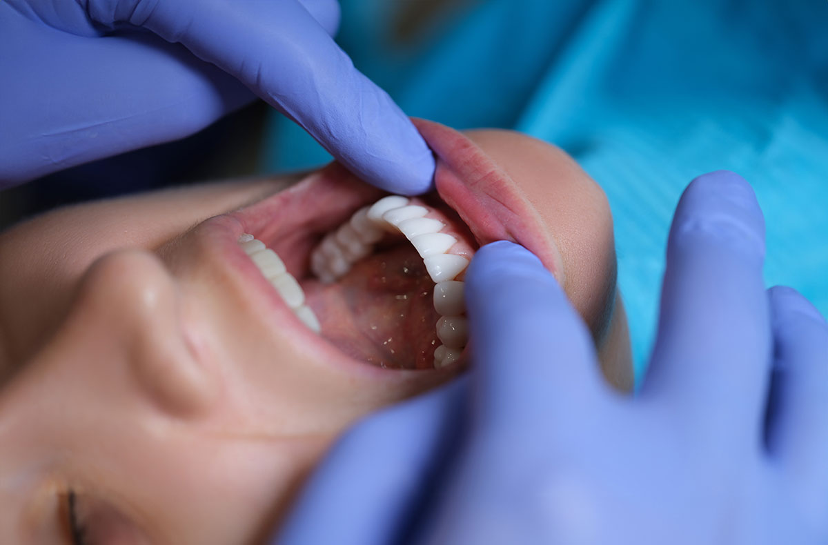 dentist checking dental veneers