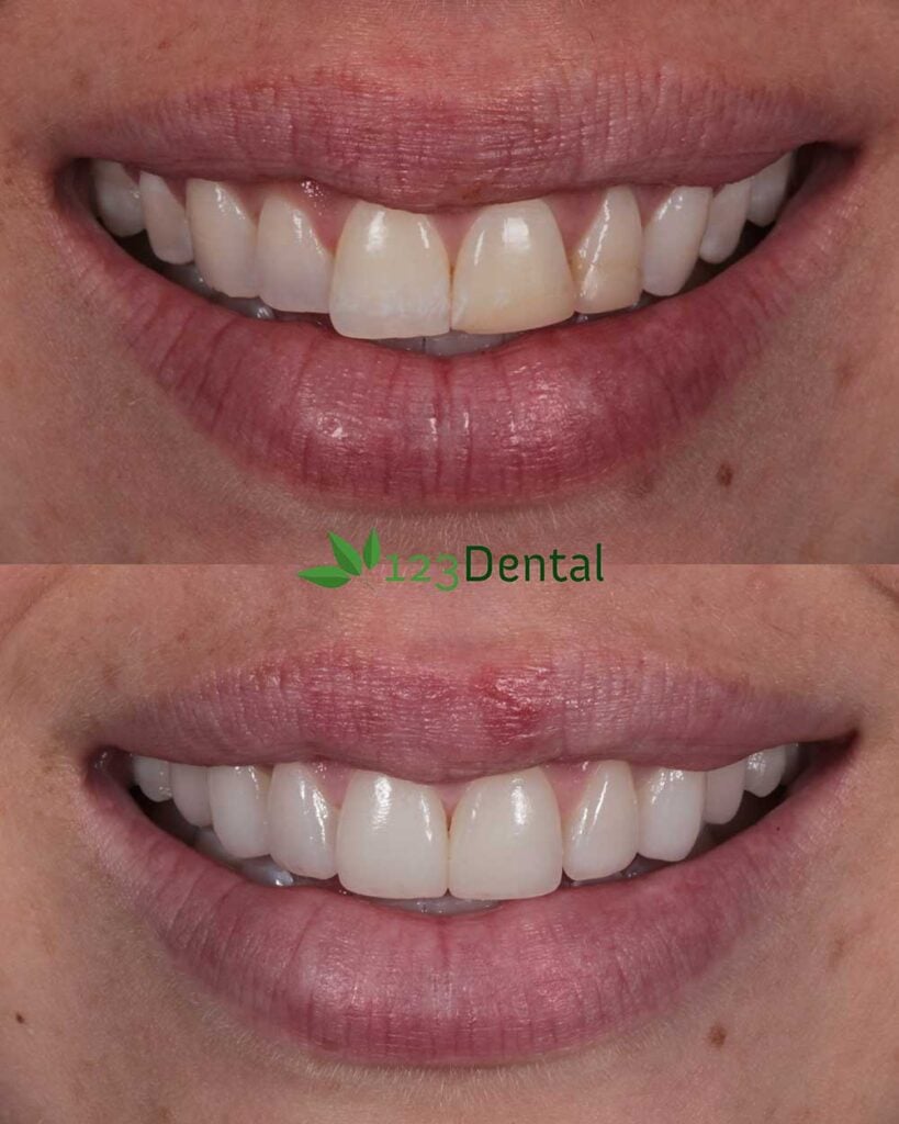 New teeth, veneers before and after