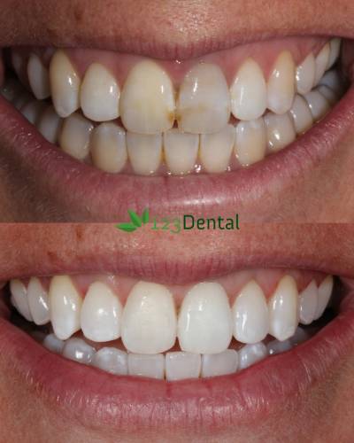Before and after teeth whitening with 123 dental