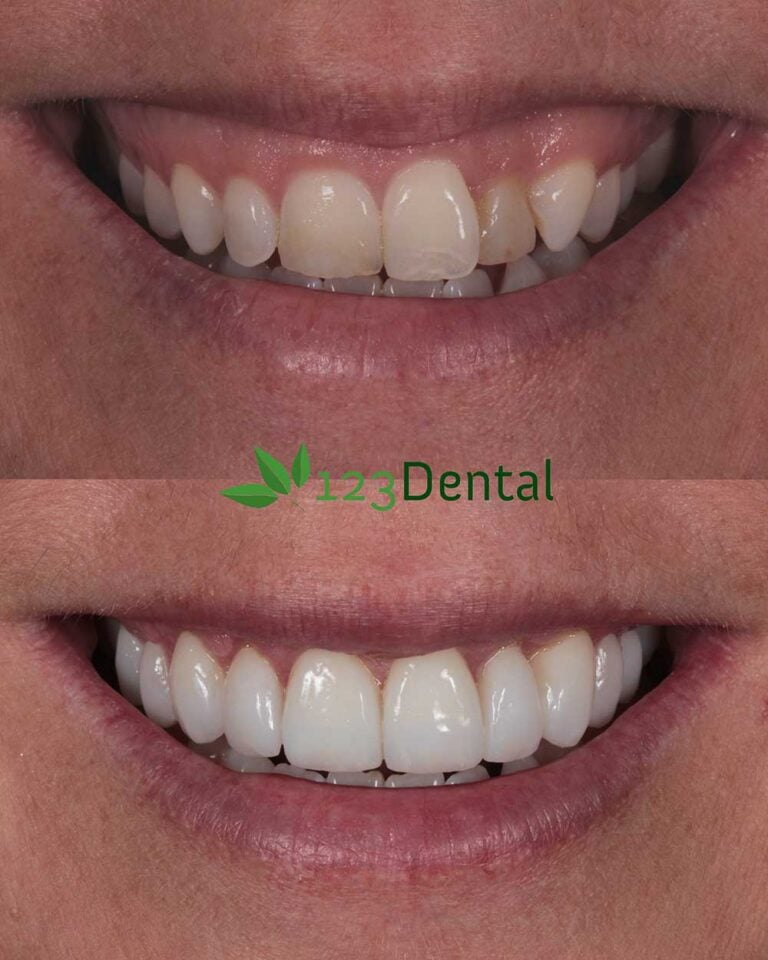 Perth veneers