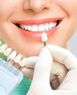 Dental veneers
