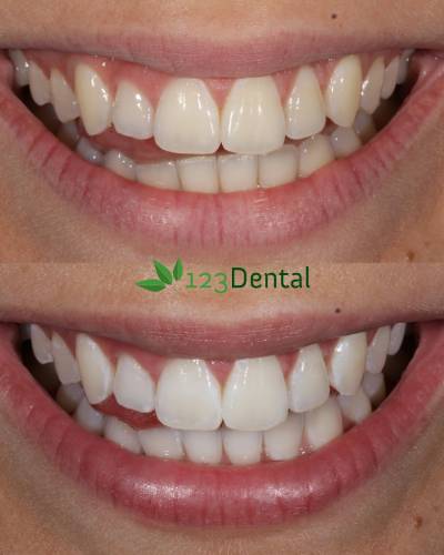 Teeth before and after professional whitening