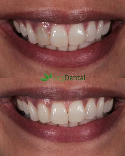Tooth one week after internal bleaching
