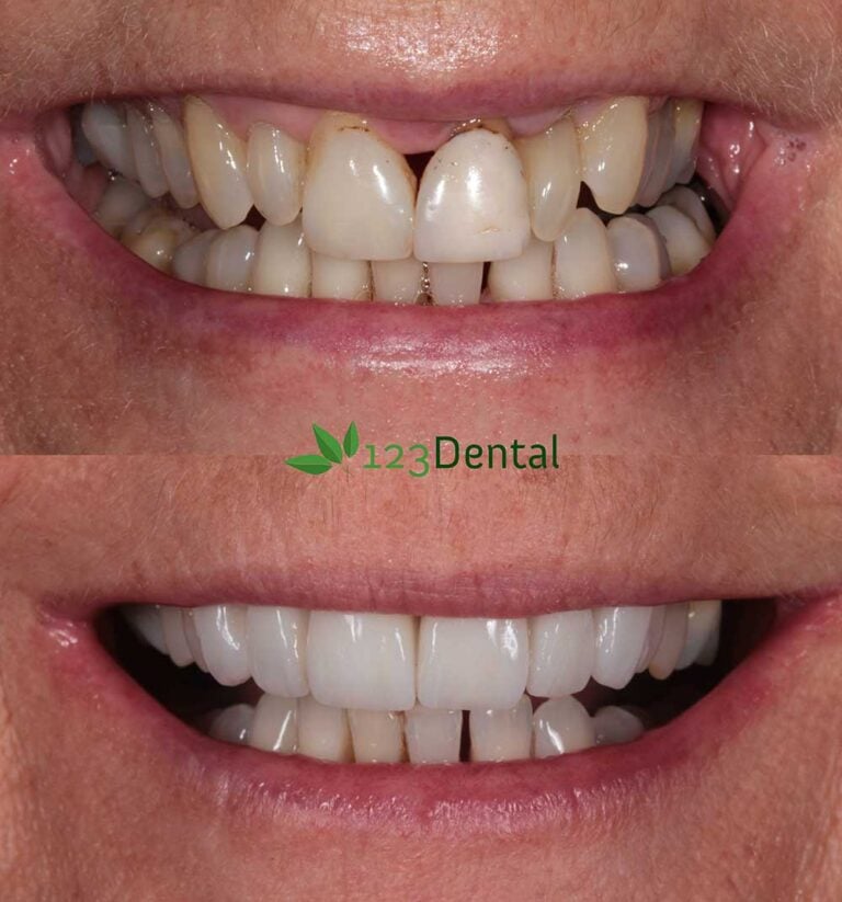 Veneers before and after