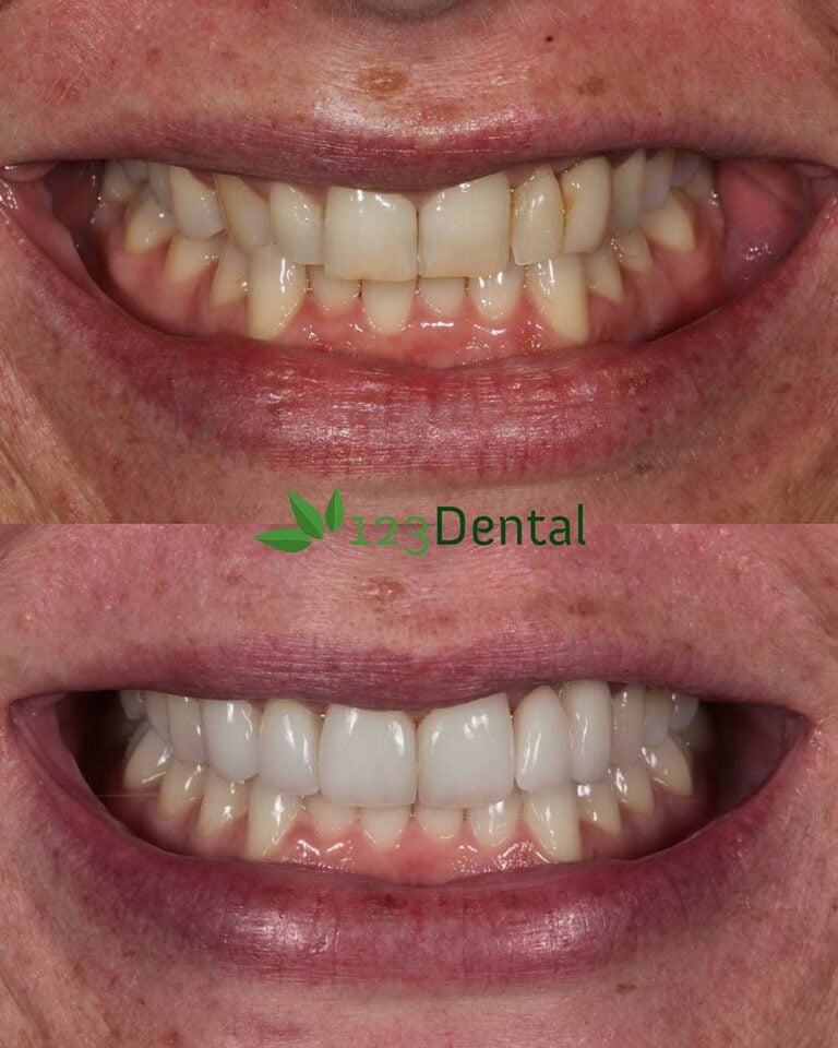 Veneers transformation