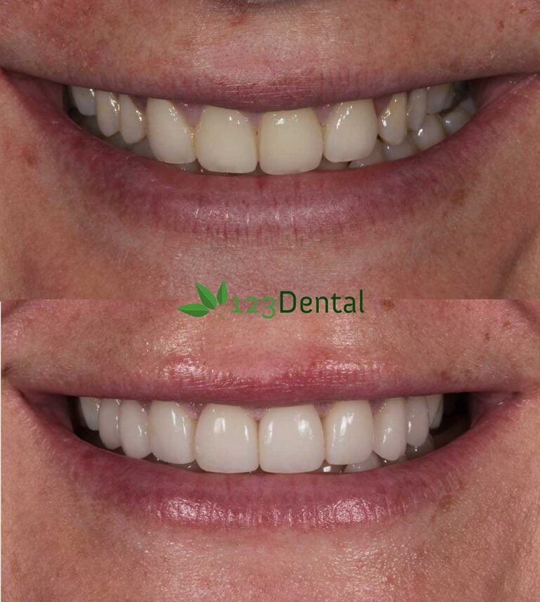 Before and after porcelain veneer