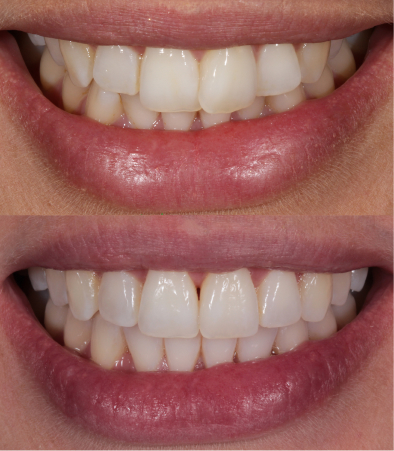 Teeth before and after Invisalign treatment
