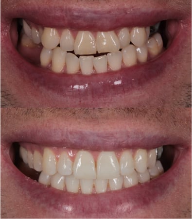 Teeth before and after dental crown