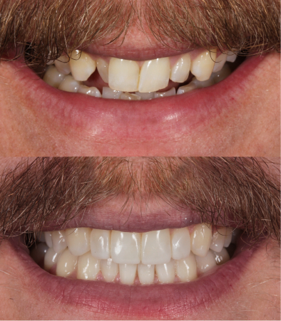 Teeth before and after Invisalign treatment