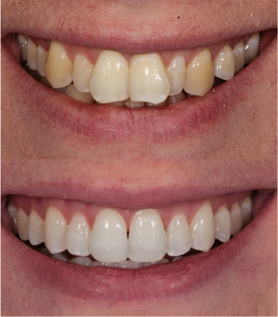 Teeth before and after Invisalign treatment