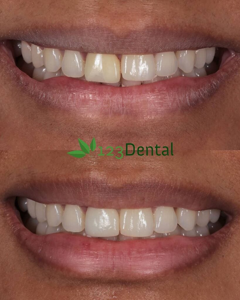 Before and after treatment