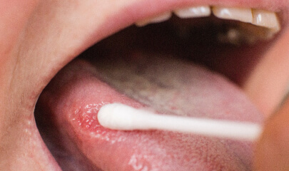 Close-up of a person with a sore bitten lip