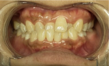 Diagram of a crossbite, where upper teeth sit inside the lower teeth