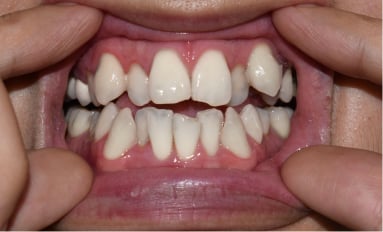 Close-up of crowded teeth, with upper side teeth pushed behind the front teeth and lower teeth overlapping