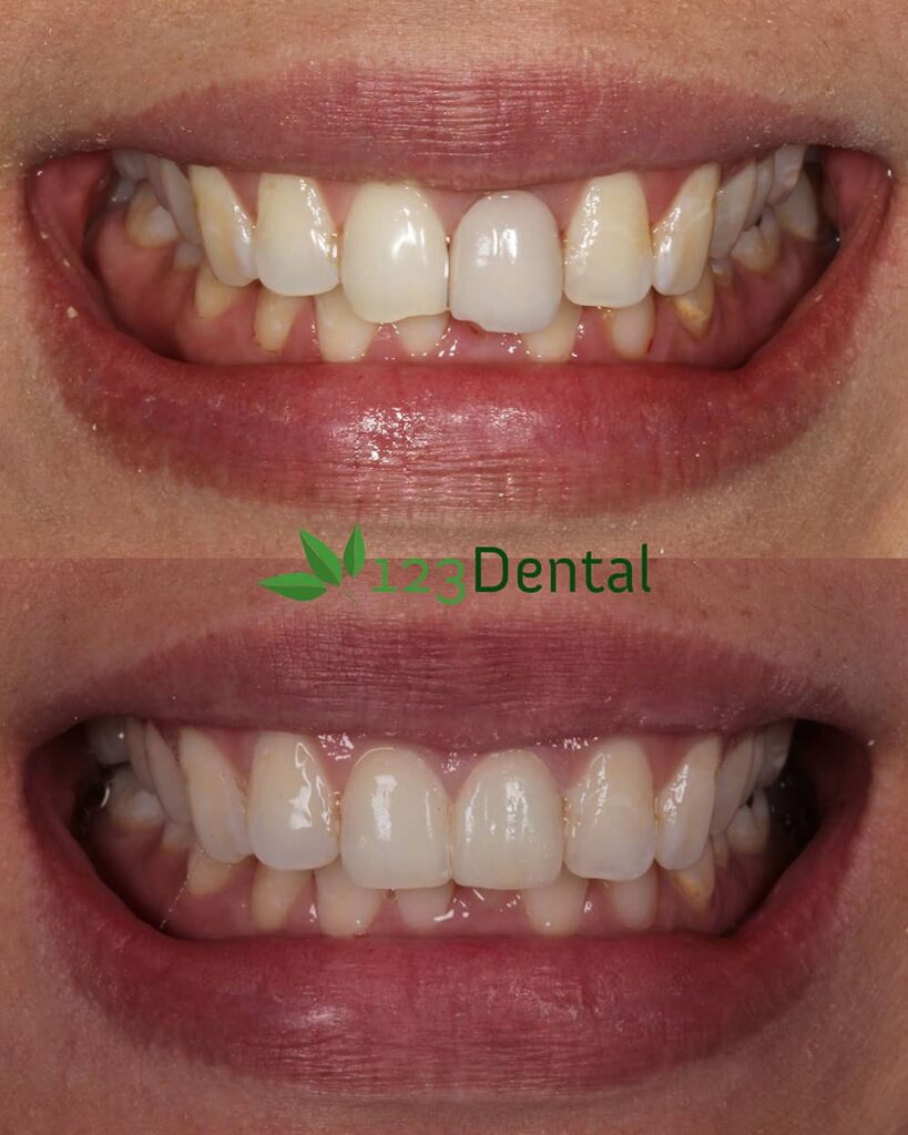 Patient with happy smile after crowns