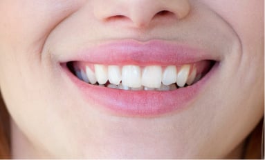 Close-up smile where the upper front teeth overlap the lower ones, as happens with a deep bite