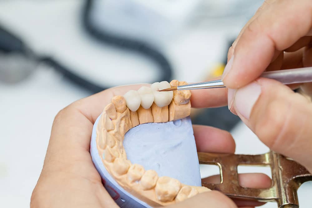Dentist creating dental bridge