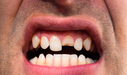 Close-up of a fractured or chipped tooth