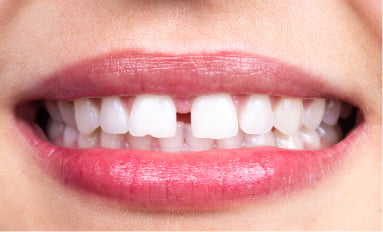 Close-up of a smile showing a noticeable gap between the two upper front teeth
