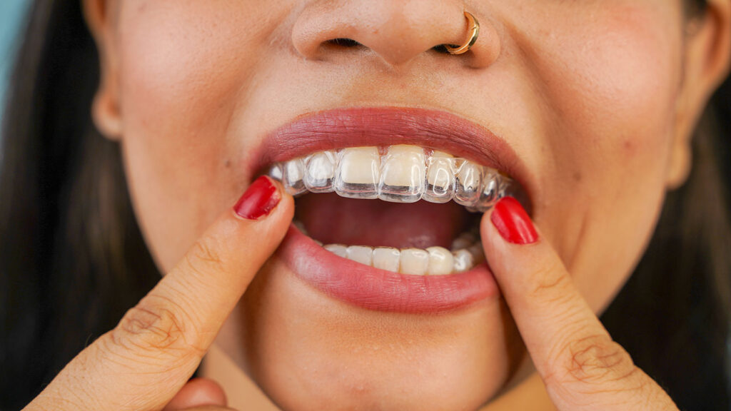 Women inserting invisalign