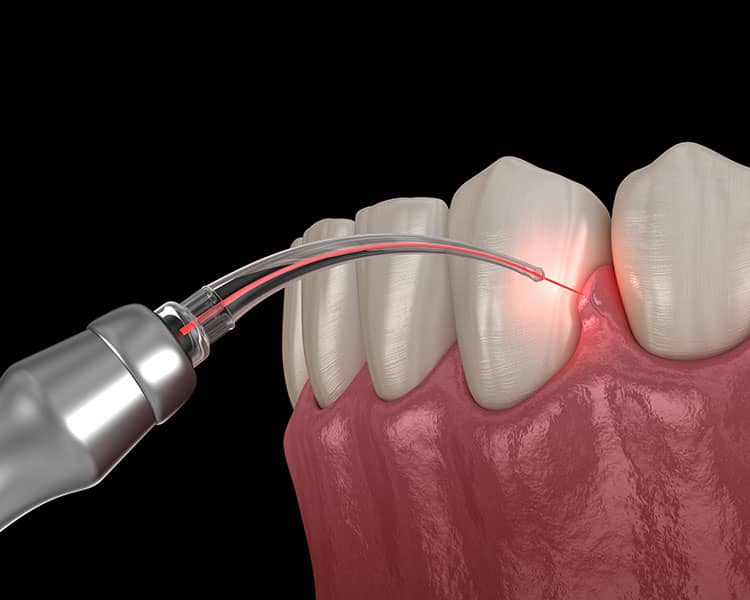 3D render of a dental laser directing a red beam at the gumline where it meets a tooth
