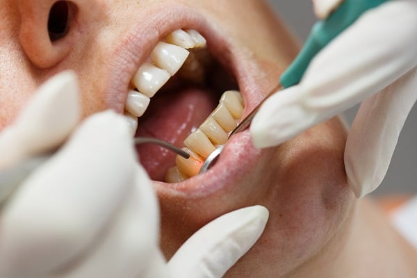 Close-up dental examination and scaling procedure