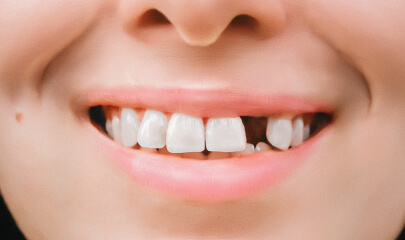Close-up of a lost dental filling or crown