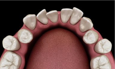3D illustration of a lower dental arch showing crowded, overlapping and rotated front teeth