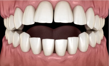 Anterior open bite, where the upper and lower front teeth leave a gap when the back teeth close