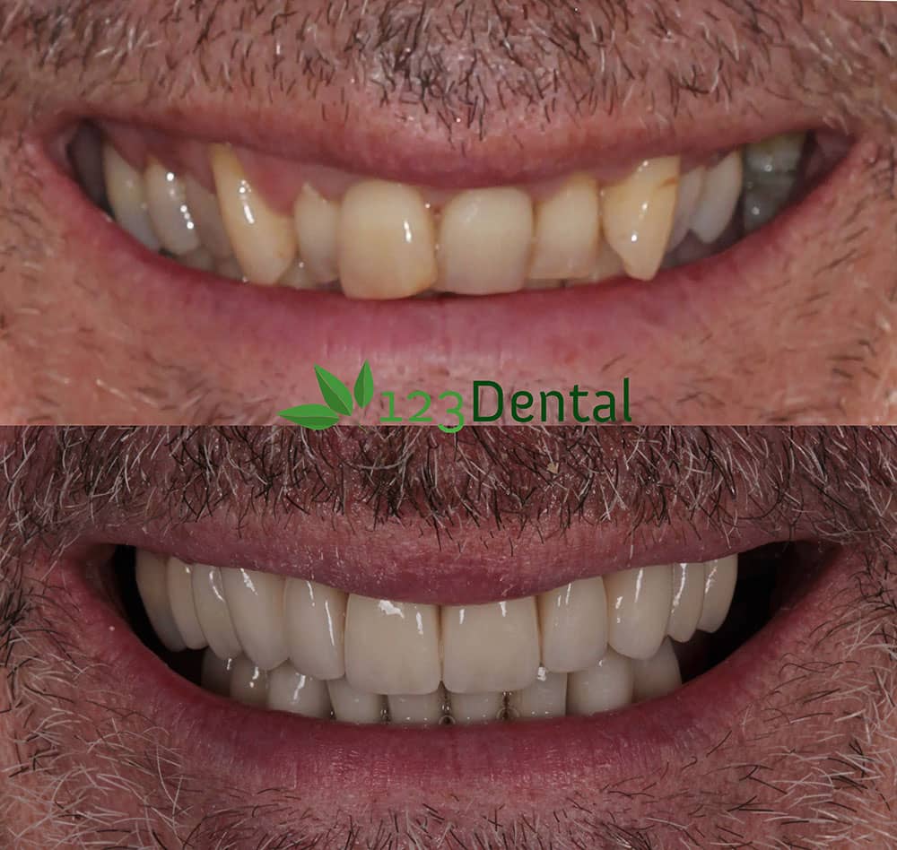 Smile improvements with crowns