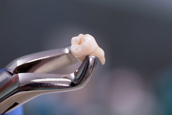 An extracted molar, roots intact, gripped in the beaks of dental extraction forceps