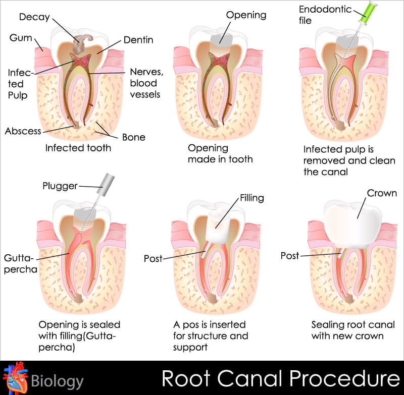 Six-stage root canal diagram: infected pulp, access opening, cleaning, gutta-percha, post, then crown